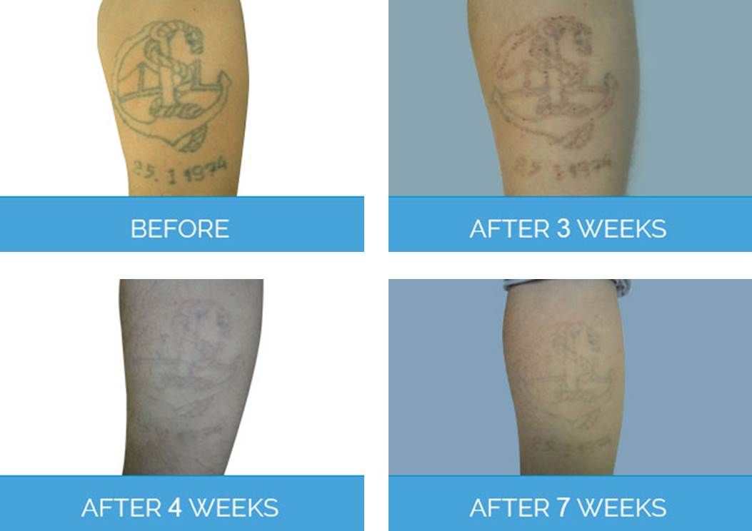 Laser Tattoo Removal London, Cost, Risk, Benefit 